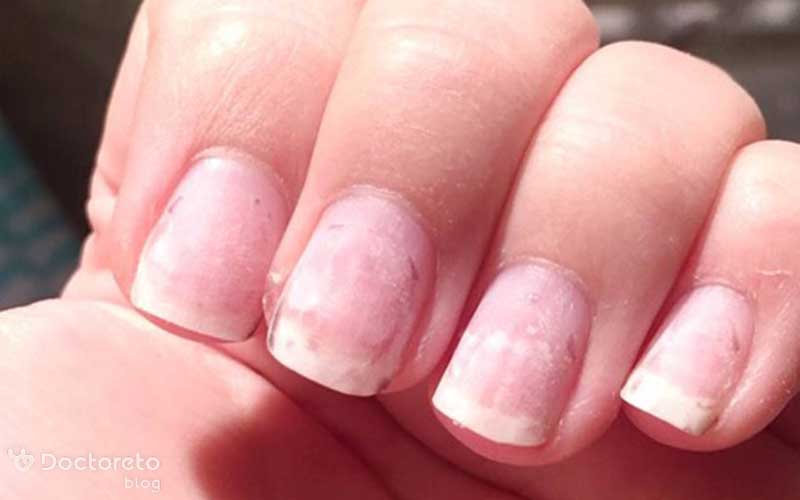 هوا گرفتن در کاشت ناخن