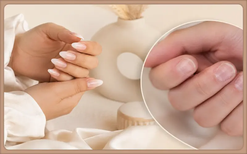 کاشت روی ناخن آسیب دیده