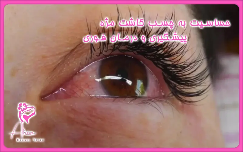 حساسیت به چسب مژه