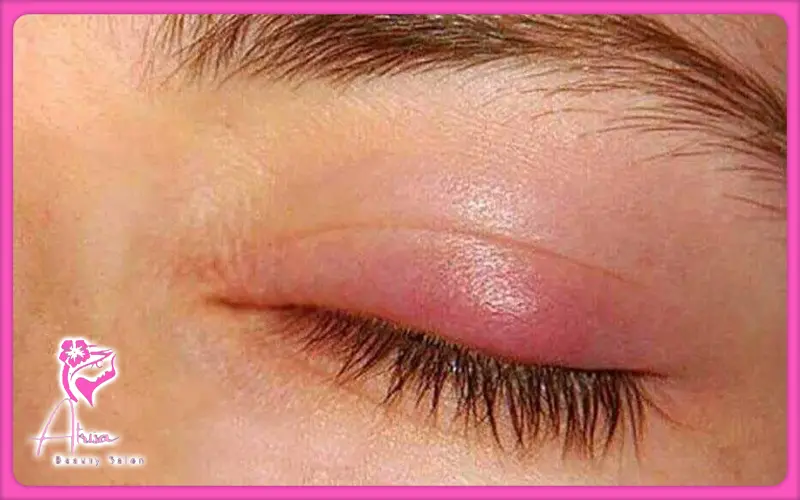 مزایا و معایب کاشت مژه از نظر سلامت چشم