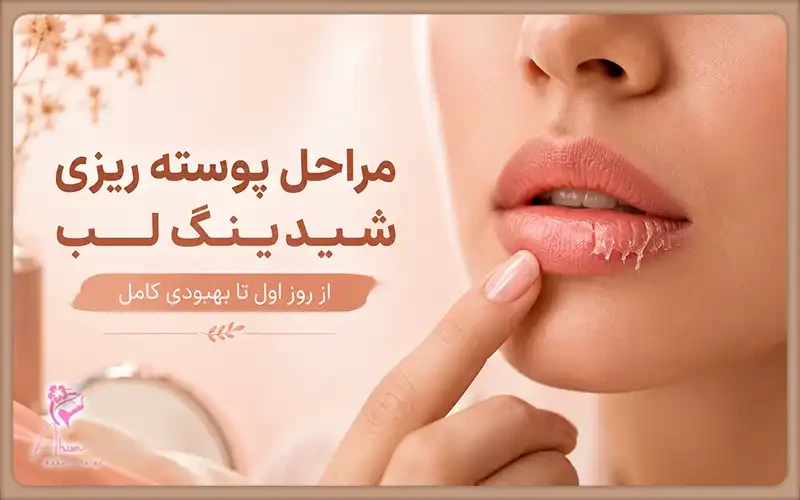 مرحله های پوسته ریزی شیدینگ لب